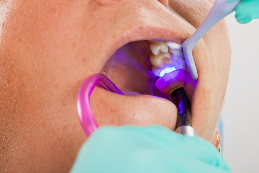 garland dental fillings