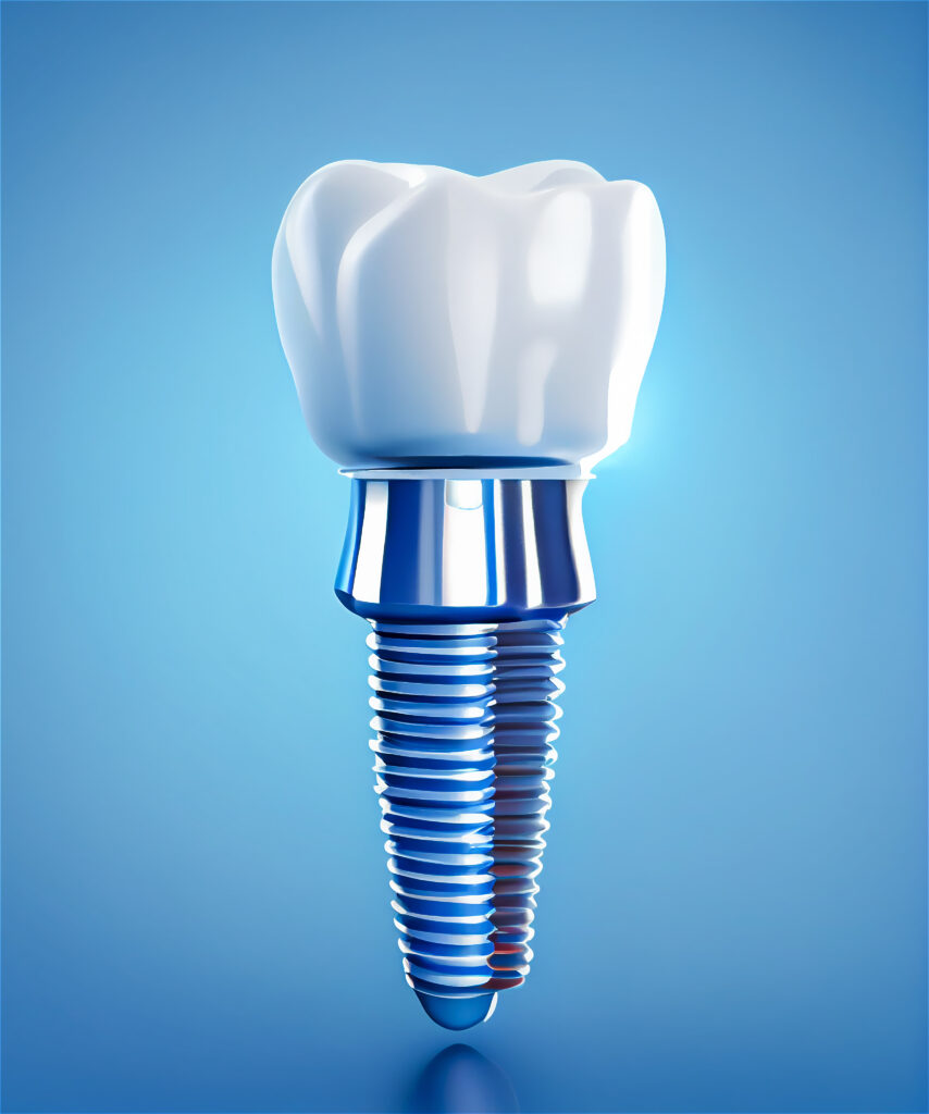 3D rendering of a dental implant on a blue background
