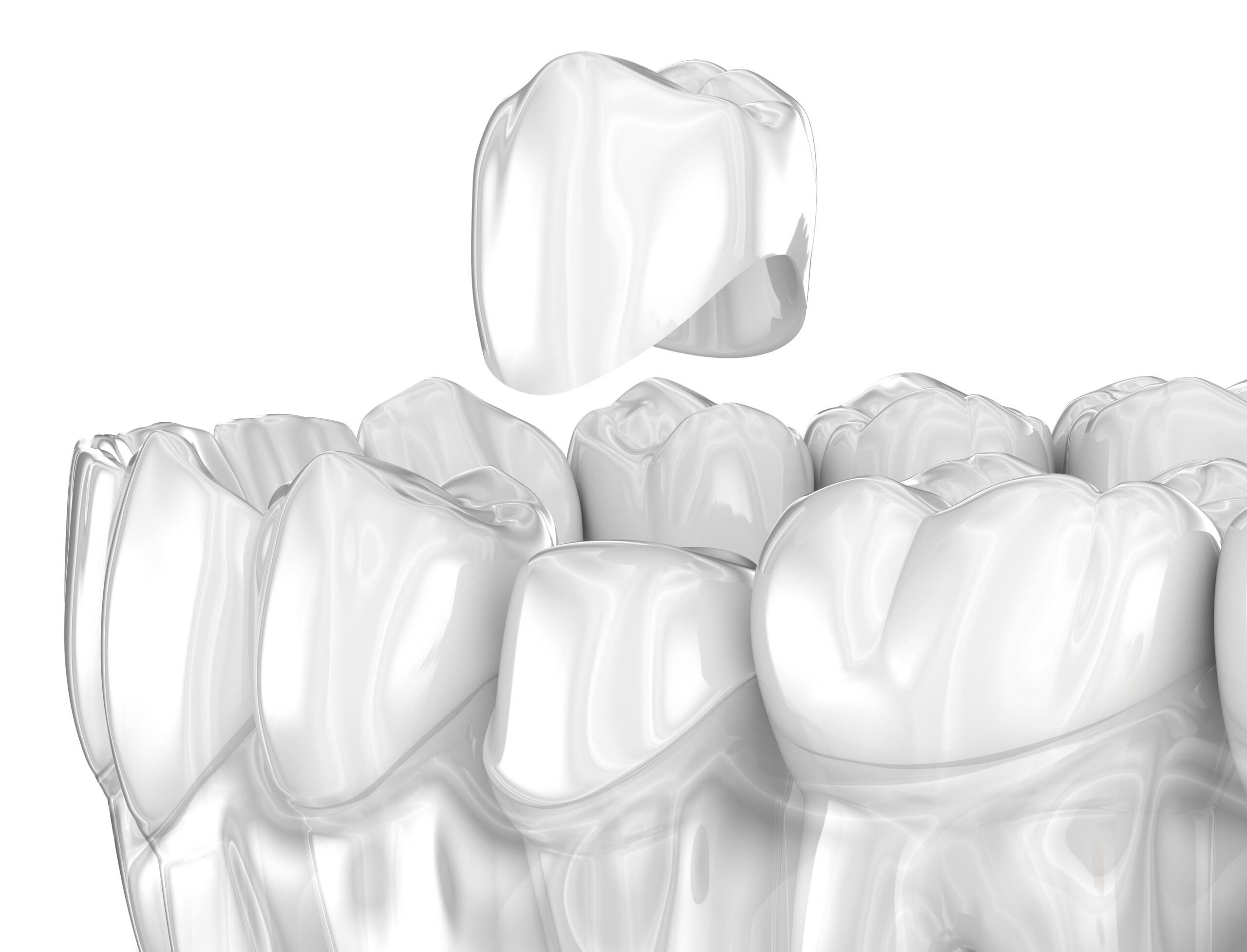 Creating NaturalLooking Dental Crowns Garland, TX Creating NaturalLooking Dental Crowns Garland, TX
