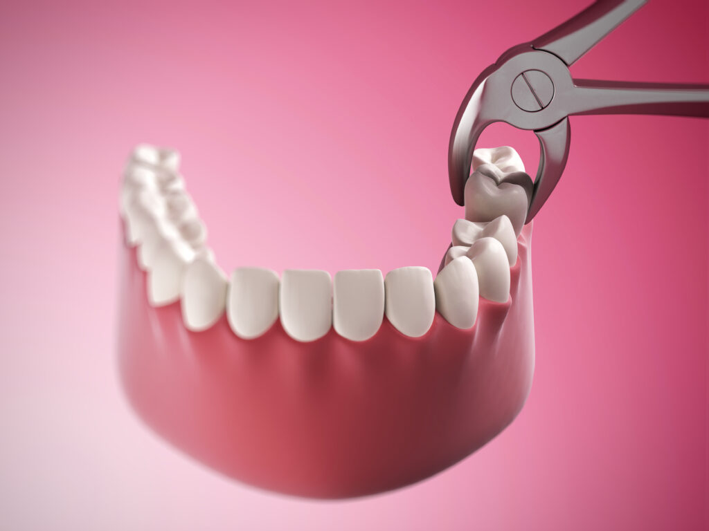 garland tooth extraction